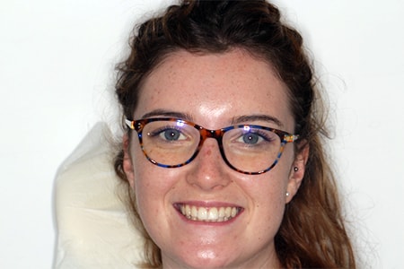 Before and After Invisalign Treatment Wokingham Before and After Invisalign Treatment Wokingham