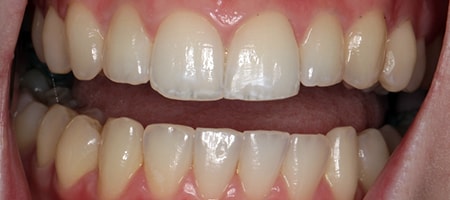 Before and After Invisalign Treatment Wokingham Before and After Invisalign Treatment Wokingham