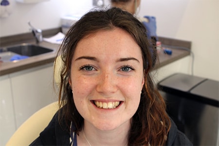 Before and After Invisalign Treatment Wokingham Before and After Invisalign Treatment Wokingham