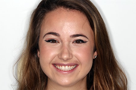 Before and After Invisalign Treatment Wokingham Before and After Invisalign Treatment Wokingham