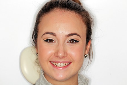 Before and After Invisalign Treatment Wokingham Before and After Invisalign Treatment Wokingham