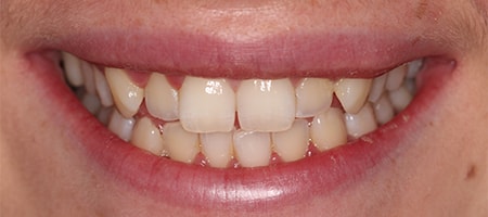 Before and After Invisalign Treatment Wokingham Before and After Invisalign Treatment Wokingham