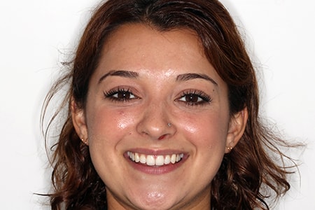 Before and After Invisalign Treatment Wokingham Before and After Invisalign Treatment Wokingham