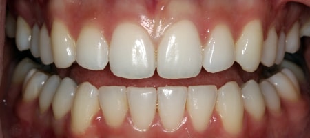 Before and After Invisalign Treatment Wokingham Before and After Invisalign Treatment Wokingham