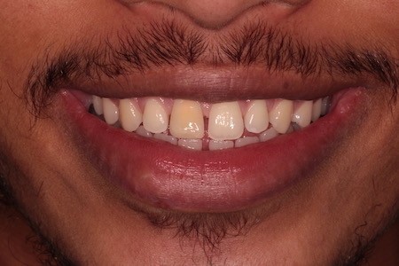 Before and After Invisalign Treatment Wokingham
