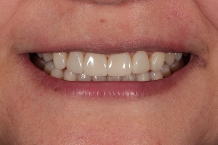 Before and After Invisalign Treatment Wokingham