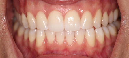 Before and After Invisalign Treatment Wokingham Before and After Invisalign Treatment Wokingham