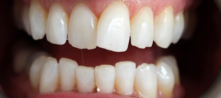 Before and After Invisalign Treatment Wokingham Before and After Invisalign Treatment Wokingham