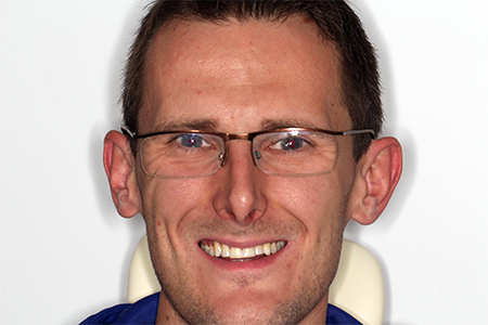 Before and After Invisalign Treatment Wokingham Before and After Invisalign Treatment Wokingham