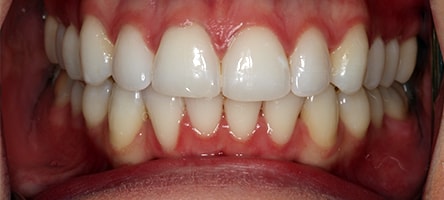 Before and After Invisalign Treatment Wokingham Before and After Invisalign Treatment Wokingham