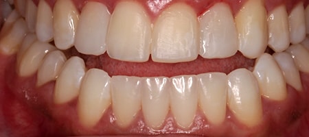 Before and After Invisalign Treatment Wokingham Before and After Invisalign Treatment Wokingham