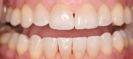 Before and After Invisalign Treatment Wokingham Before and After Invisalign Treatment Wokingham