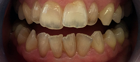 Before and After Invisalign Treatment Wokingham Before and After Invisalign Treatment Wokingham