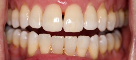Before and After Invisalign Treatment Wokingham Before and After Invisalign Treatment Wokingham
