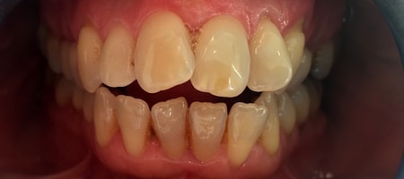 Before and After Invisalign Treatment Wokingham Before and After Invisalign Treatment Wokingham