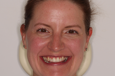 Before and After Invisalign Treatment Wokingham Before and After Invisalign Treatment Wokingham