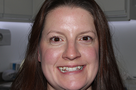 Before and After Invisalign Treatment Wokingham Before and After Invisalign Treatment Wokingham