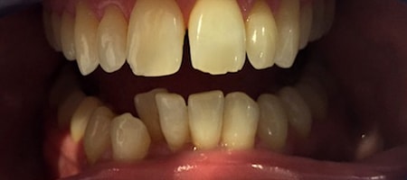 Before and After Invisalign Treatment Wokingham Before and After Invisalign Treatment Wokingham