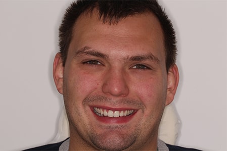 Before and After Invisalign Treatment Wokingham Before and After Invisalign Treatment Wokingham