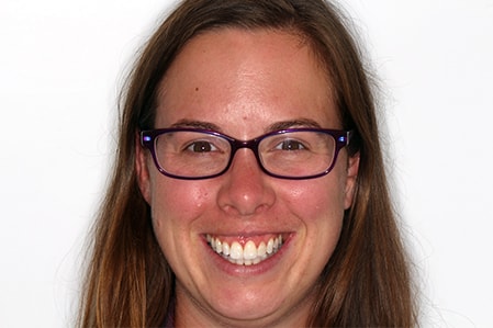 Before and After Invisalign Treatment Wokingham Before and After Invisalign Treatment Wokingham