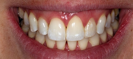 Before and After Invisalign Treatment Wokingham Before and After Invisalign Treatment Wokingham