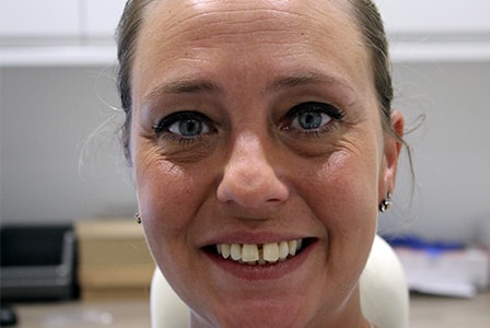 Before and After Invisalign Treatment Wokingham Before and After Invisalign Treatment Wokingham