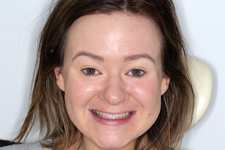 Before and After Invisalign Treatment Wokingham Before and After Invisalign Treatment Wokingham