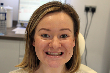 Before and After Invisalign Treatment Wokingham Before and After Invisalign Treatment Wokingham