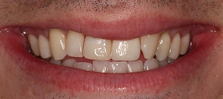 Before and After Invisalign Treatment Wokingham