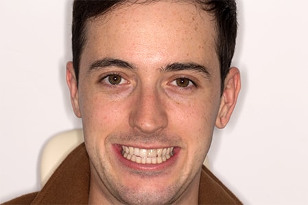 Before and After Invisalign Treatment Wokingham