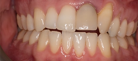 Before and After Invisalign Treatment Wokingham