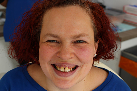 Before Invisalign Treatment Smile Rooms Glasgow Before Invisalign Treatment Smile Rooms Glasgow