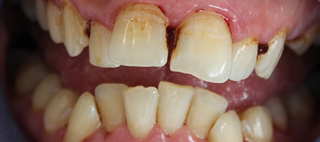 Before Invisalign Treatment Smile Rooms Glasgow Before Invisalign Treatment Smile Rooms Glasgow