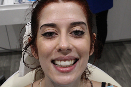 Before and After Invisalign Treatment Wokingham