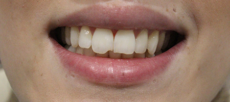 Before and After Invisalign Treatment Wokingham