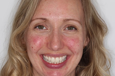 Before and After Invisalign Treatment Wokingham Before and After Invisalign Treatment Wokingham