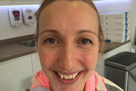 Before and After Invisalign Treatment Wokingham Before and After Invisalign Treatment Wokingham