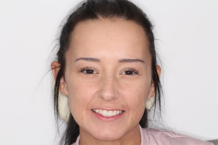 Before and After Invisalign Treatment Wokingham Before and After Invisalign Treatment Wokingham