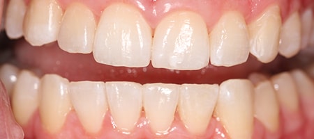 Before and After Invisalign Treatment Wokingham Before and After Invisalign Treatment Wokingham
