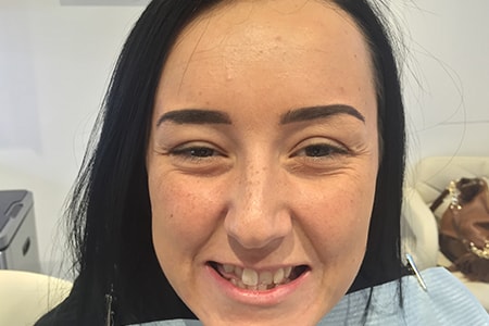 Before and After Invisalign Treatment Wokingham Before and After Invisalign Treatment Wokingham