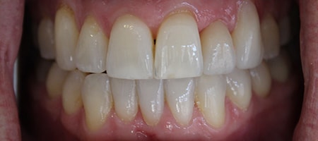 Before and After Invisalign Treatment Wokingham Before and After Invisalign Treatment Wokingham