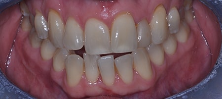Before and After Invisalign Treatment Wokingham Before and After Invisalign Treatment Wokingham