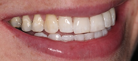 Before and After Invisalign Treatment Wokingham Before and After Invisalign Treatment Wokingham