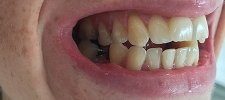 Before and After Invisalign Treatment Wokingham Before and After Invisalign Treatment Wokingham