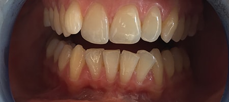Before and After Invisalign Treatment Wokingham Before and After Invisalign Treatment Wokingham