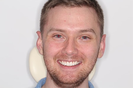 Before and After Invisalign Treatment Wokingham Before and After Invisalign Treatment Wokingham