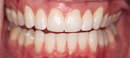 Before and After Invisalign Treatment Wokingham Before and After Invisalign Treatment Wokingham