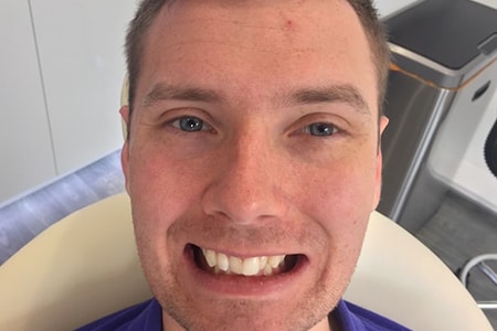 Before and After Invisalign Treatment Wokingham Before and After Invisalign Treatment Wokingham