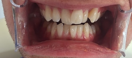 Before and After Invisalign Treatment Wokingham Before and After Invisalign Treatment Wokingham