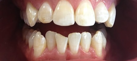 Before and After Invisalign Treatment Wokingham Before and After Invisalign Treatment Wokingham